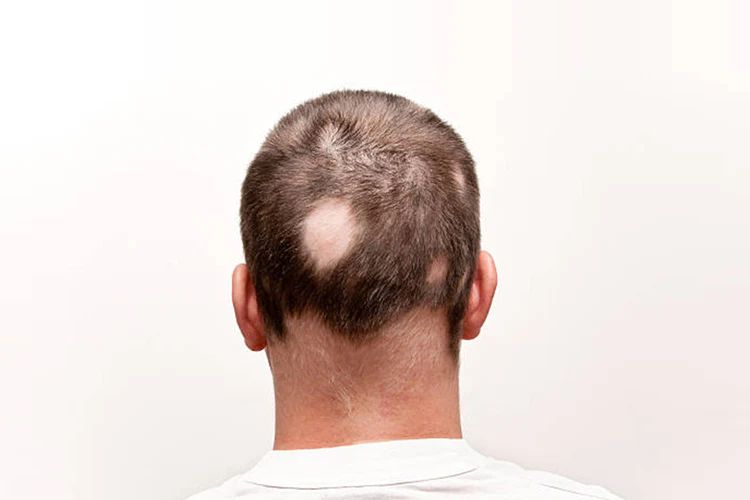 Alopecia: Understanding the Condition, Its Lifestyle Triggers, and How Homeopathy Can Help