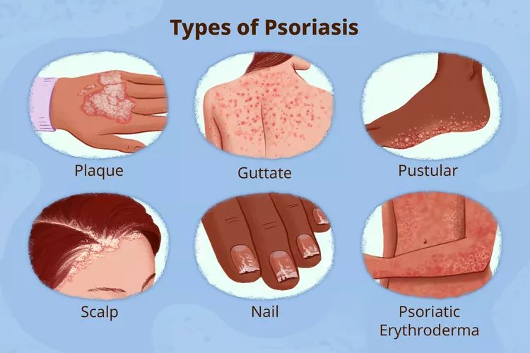 Psoriasis: Understanding the Condition, Symptoms, and Homeopathic Solutions