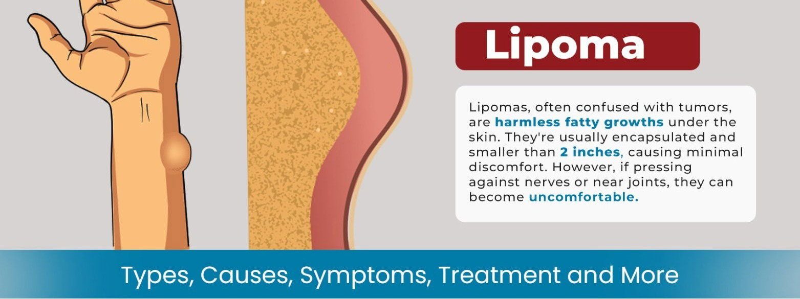 Lipoma: Causes, Symptoms, and Homeopathic Treatment in Noida & NCR